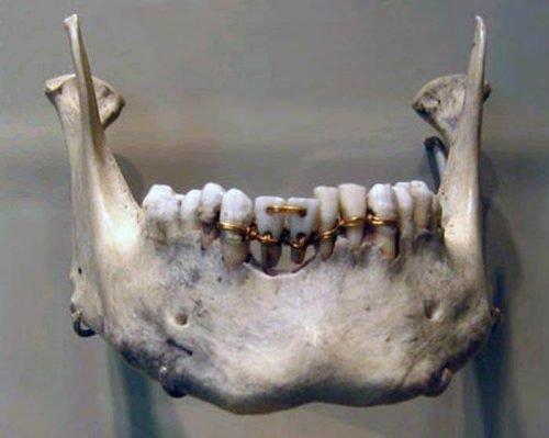 Мостики между зубами и коронки из Древнего Египта. (2900-2750 гг. до н.э.)
